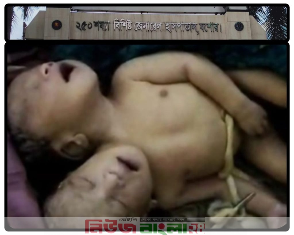 যশোর শার্শা বাগআঁচড়ায় একটি বেসরকারি হাসপাতালে দুই মাথা নিয়ে শিশুর জন্মের পর ও মৃত্যু